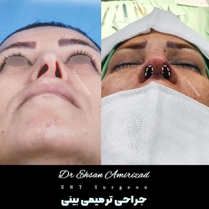 جراحی-بینی-10