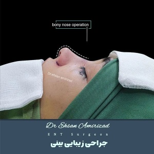 جراحی-بینی-11