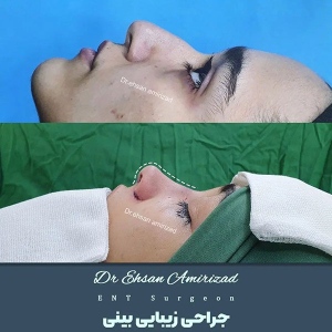 جراحی-بینی-12