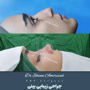 جراحی-بینی-13