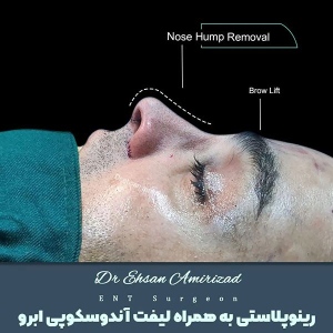 جراحی-بینی-15