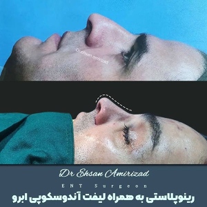 جراحی-بینی-16