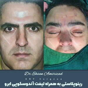 جراحی-بینی-17