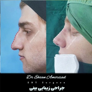 جراحی-بینی-2