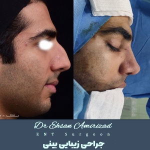 جراحی-بینی-20
