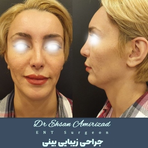 جراحی-بینی-22