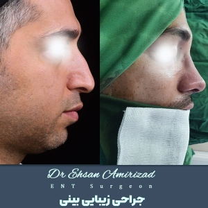 جراحی-بینی-24