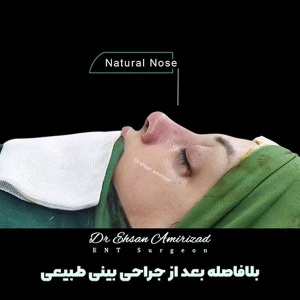 جراحی-بینی-25