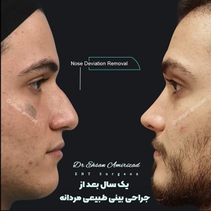 جراحی-بینی-26