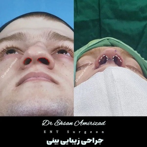 جراحی-بینی-3