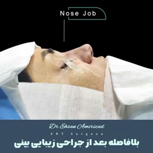 جراحی-بینی-30