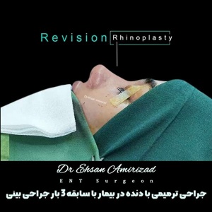 جراحی-بینی-31