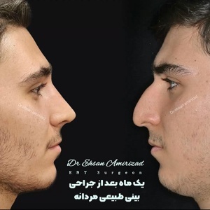 جراحی-بینی-33