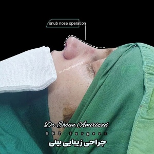 جراحی-بینی-5