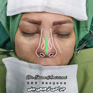 جراحی-بینی-6