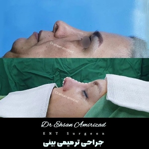جراحی-بینی-7