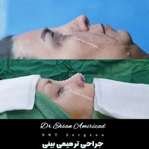 جراحی-بینی-8