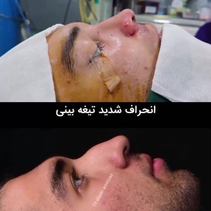 rhinoplasty-37