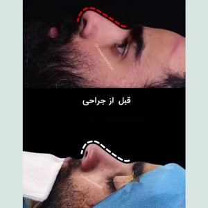 rhinoplasty-38