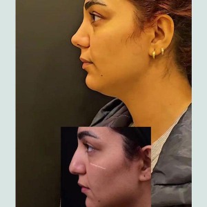 rhinoplasty-40