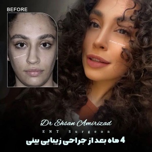 rhinoplasty-41