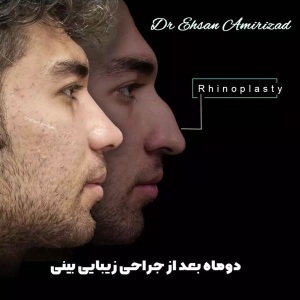 rhinoplasty-42