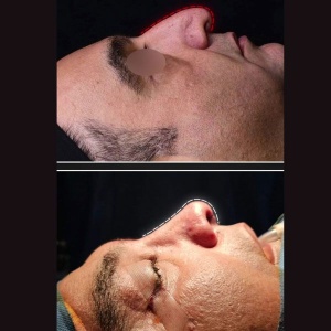 rhinoplasty-43