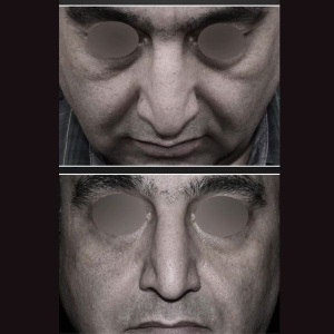 rhinoplasty-44