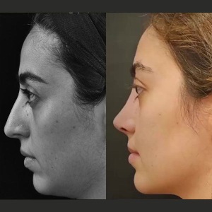 rhinoplasty-46