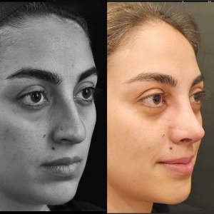 rhinoplasty-47