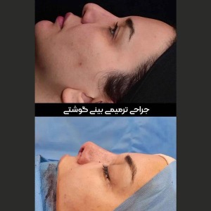 rhinoplasty-48