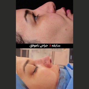 rhinoplasty-49