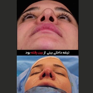 rhinoplasty-50