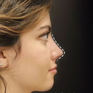 rhinoplasty-51