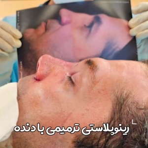 rhinoplasty-52