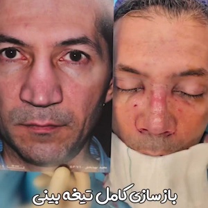 rhinoplasty-53