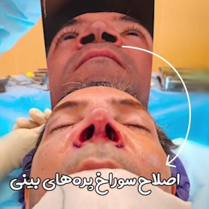 rhinoplasty-54
