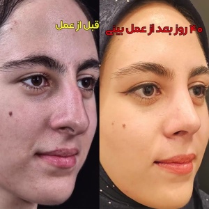 rhinoplasty-55