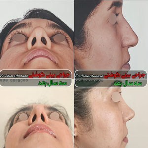 rhinoplasty-56-