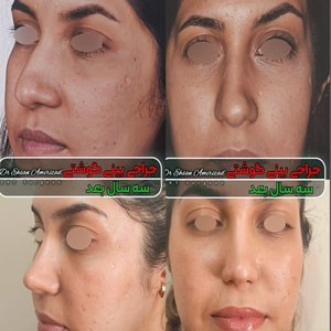 rhinoplasty-57-