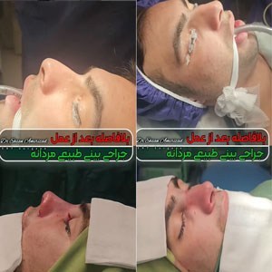 rhinoplasty-58-