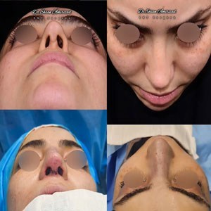 rhinoplasty-59-