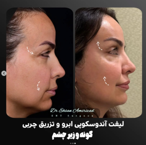 rhinoplasty-60-