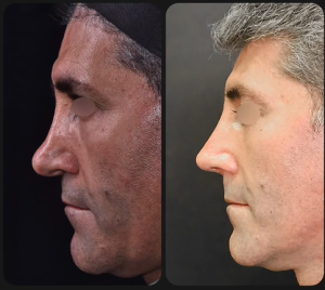rhinoplasty-61-
