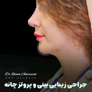 rhinoplasty-63-