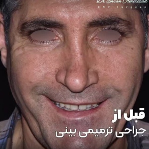 rhinoplasty-64-