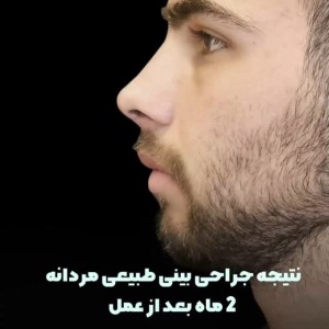 rhinoplasty-65-