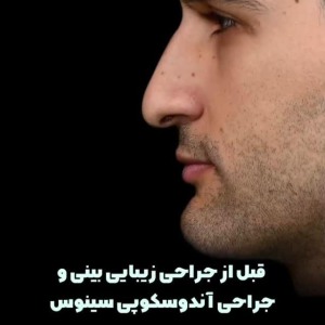 rhinoplasty-66-