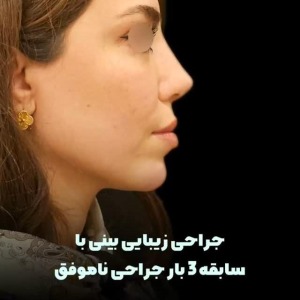 rhinoplasty-67-