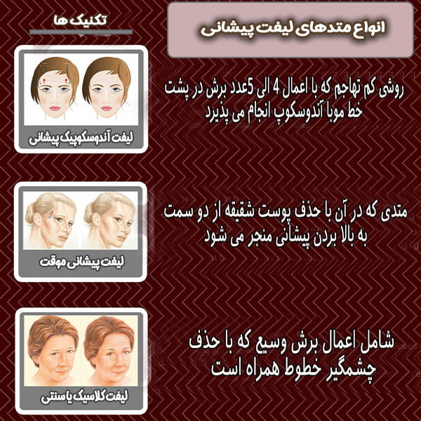 لیفت پیشانی - دکتر احسان امیری زاد